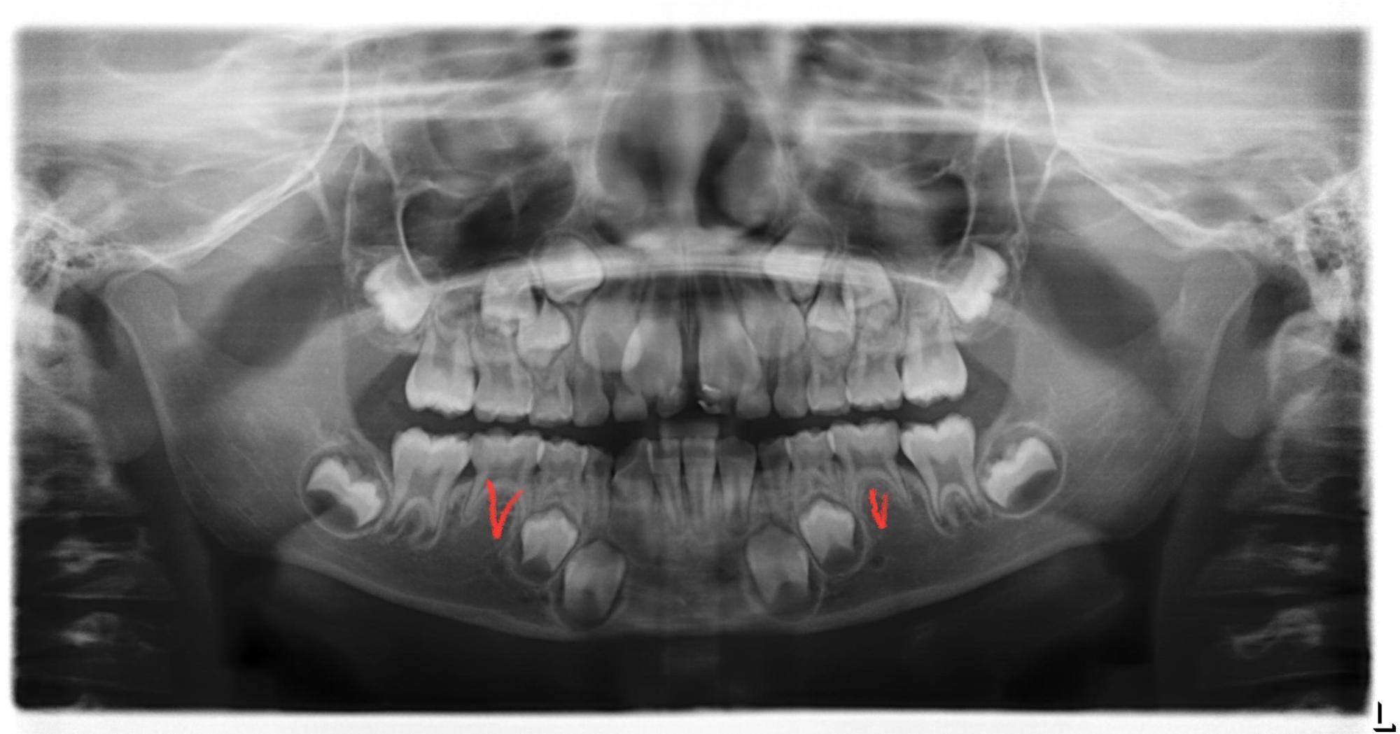 乳歯 と 永久歯 が 写っ て いる レントゲン 写真